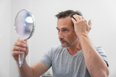 De voor- en nadelen van haarimplantatie op een rij
